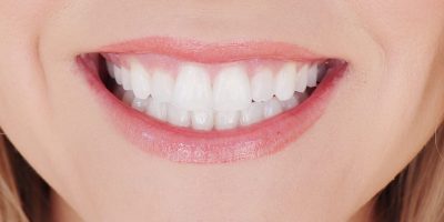 lifestyled-by-me-smile-brilliant-at-home-whitening-teeth-stains-after